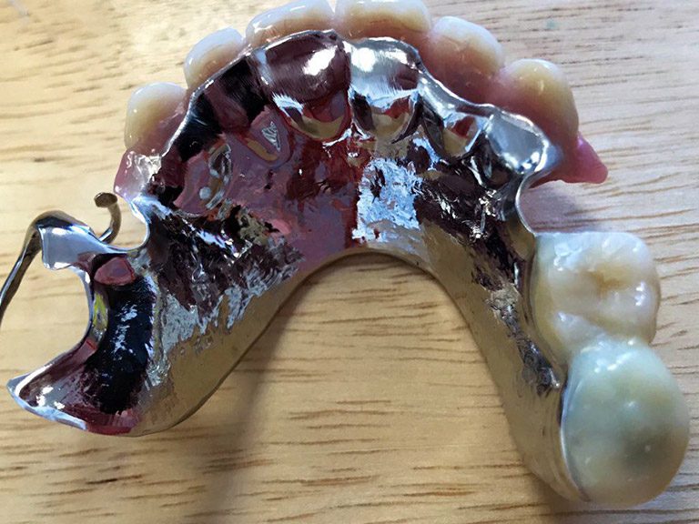 Partial Dentures Horwich Denture Clinic Bolton Lancashire Northwest Partial Dentures Horwich Denture Clinic Bolton Lancashire Northwest