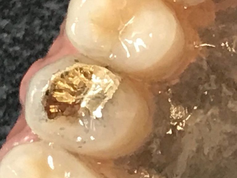 Bespoke Dentures Horwich Denture Clinic Bolton Lancashire Northwest Bespoke Dentures Horwich Denture Clinic Bolton Lancashire Northwest