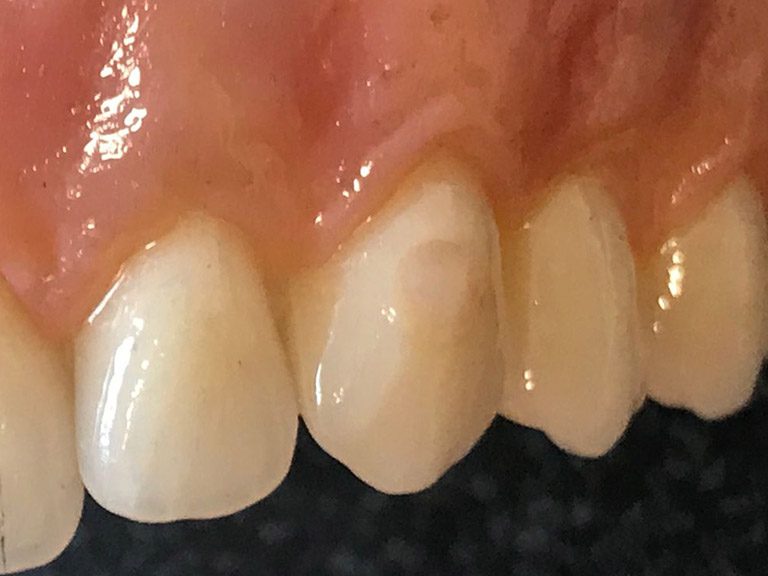 Bespoke Dentures Horwich Denture Clinic Bolton Lancashire Northwest Bespoke Dentures Horwich Denture Clinic Bolton Lancashire Northwest