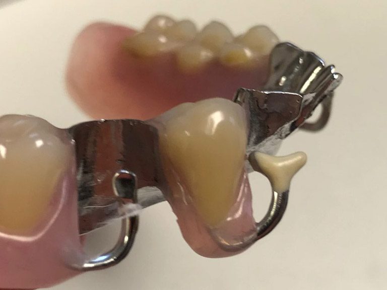 Partial Dentures Horwich Denture Clinic Bolton Lancashire Northwest Partial Dentures Horwich Denture Clinic Bolton Lancashire Northwest