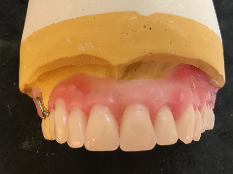 Partial Dentures Horwich Denture Clinic Bolton Lancashire Northwest Partial Dentures Horwich Denture Clinic Bolton Lancashire Northwest